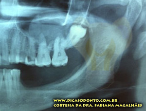 Dente do siso fora de posição Dra Fabiana Dicas Odonto