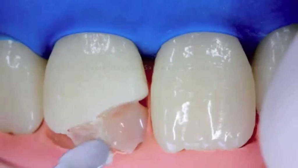 protocolo clínico classe IV