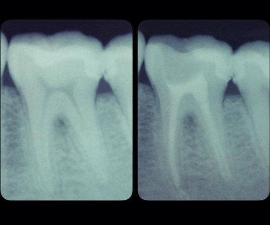 Endodontia Dicas odonto 2
