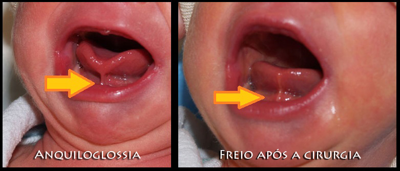 Lingua-Presa-em-Bebê Antes e depois
